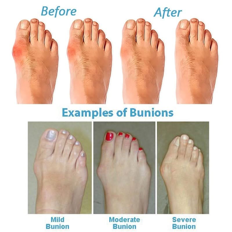 HexoBunion™ Orthopedic Bunion Corrector Sandals oaklynwear